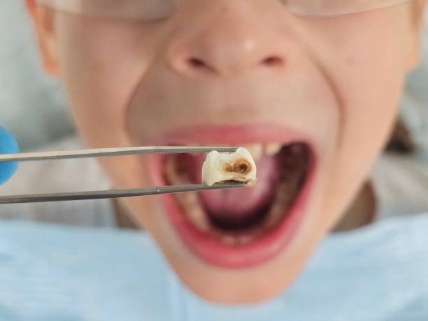 Best Emergency Tooth Extraction in Kilgore, TX